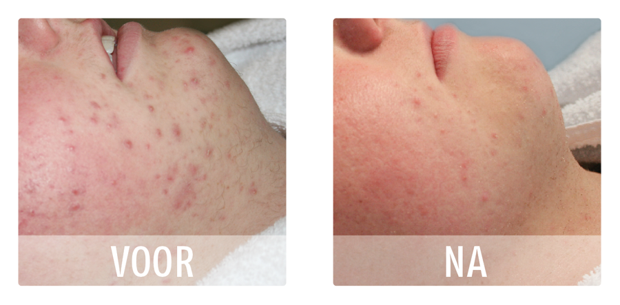 huisarts acne behandeling huisarts acne behandeling